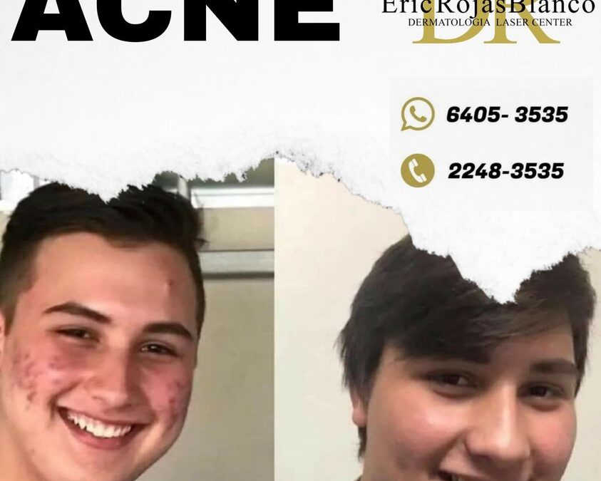 Somos el centro especializado en la eliminación de acné