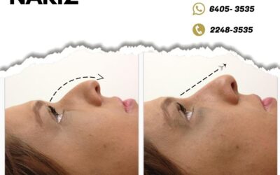 Tú también puedes mejorar el perfil de tu nariz.