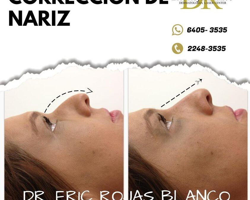 Tú también puedes mejorar el perfil de tu nariz.