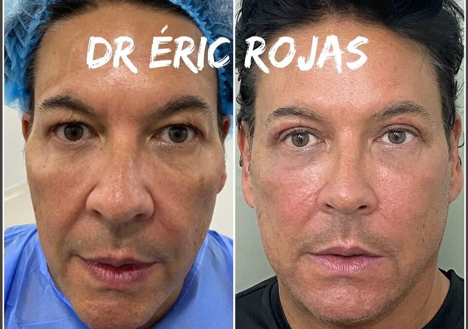 REFRESCAMIENTO FACIAL