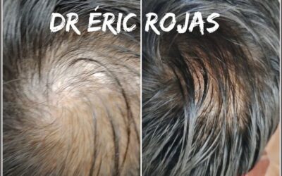 CAÍDA DE CABELLO YA NO MÁS