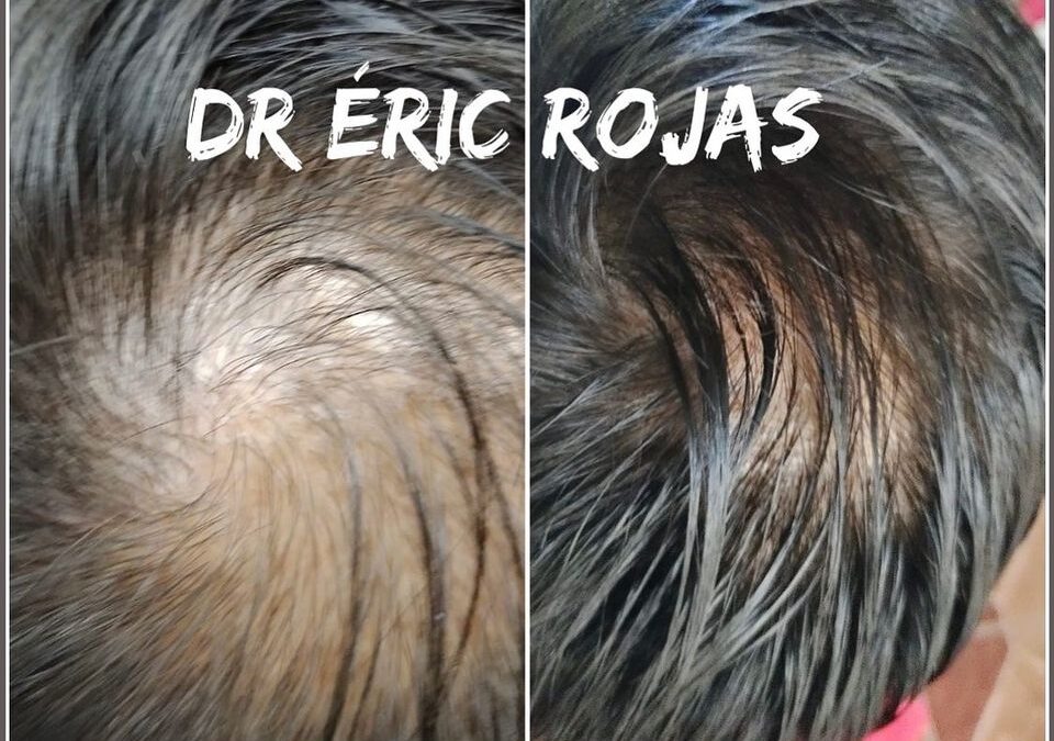 CAÍDA DE CABELLO YA NO MÁS