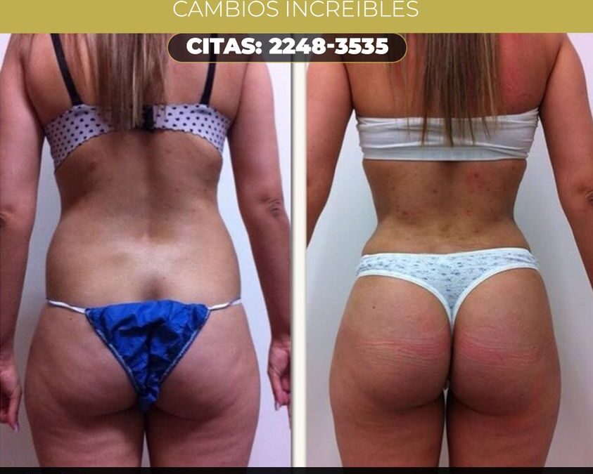 El Slim Láser puede ser la mejor opción.