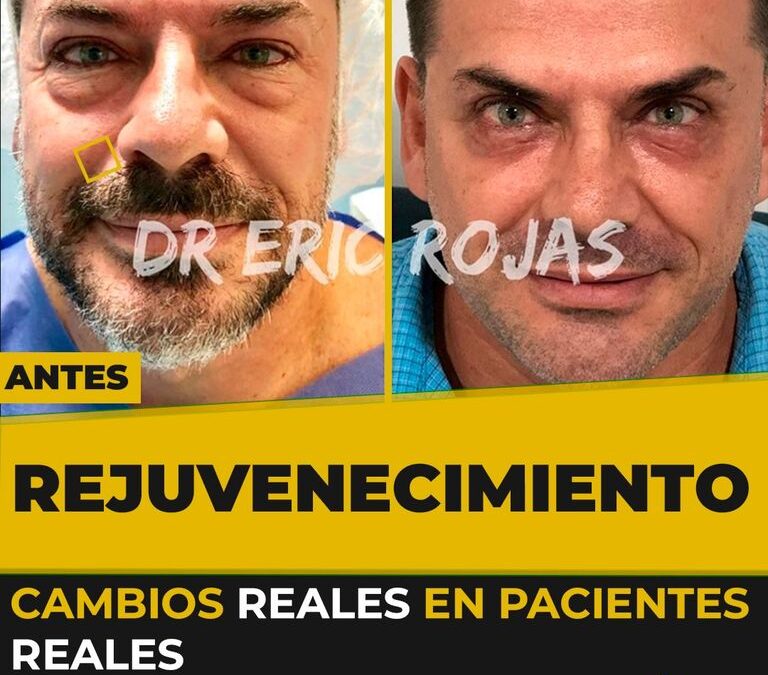 -Disminución de arrugas.