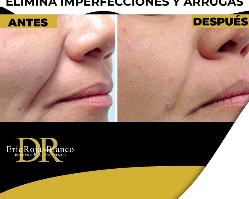 Láser fotona puede ser tu solución.😉