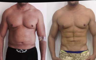 Nuestra calidad de procedimiento Slim Láser habla por si sola.