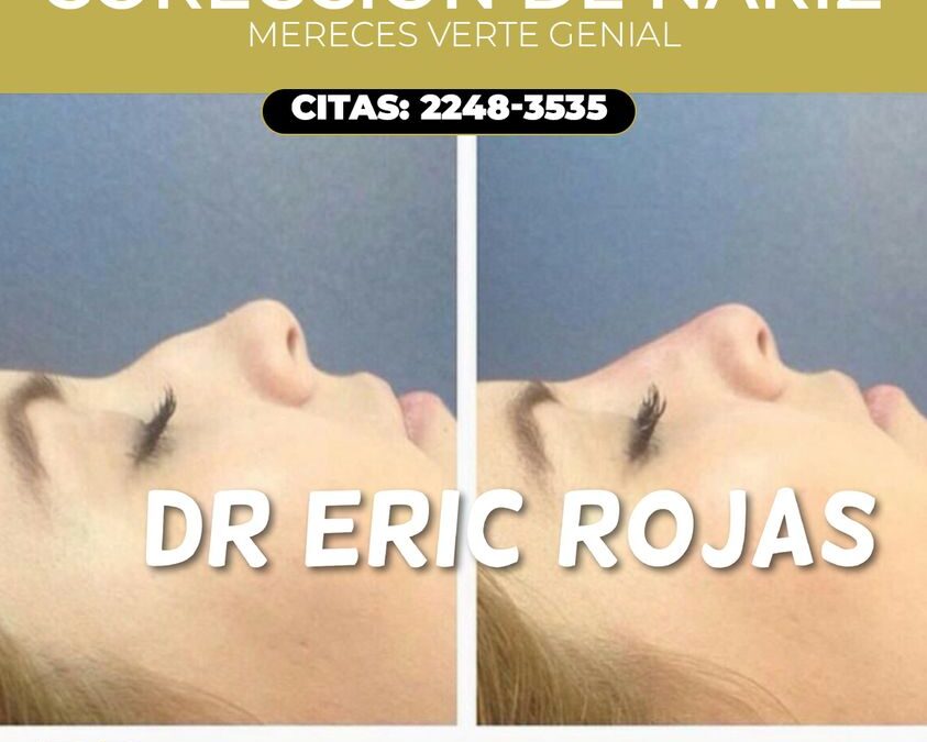 Correción de nariz con el Dr. Eric Rojas Blanco.