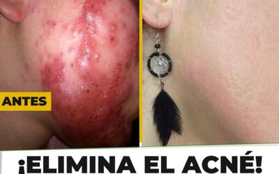 ¡Ya no más ACNÉ!