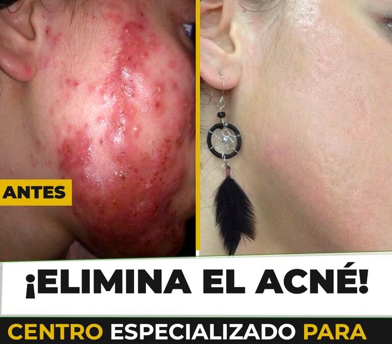 ¡Ya no más ACNÉ!
