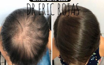 Control caida de cabello con el Dr. Eric Rojas Blanco.