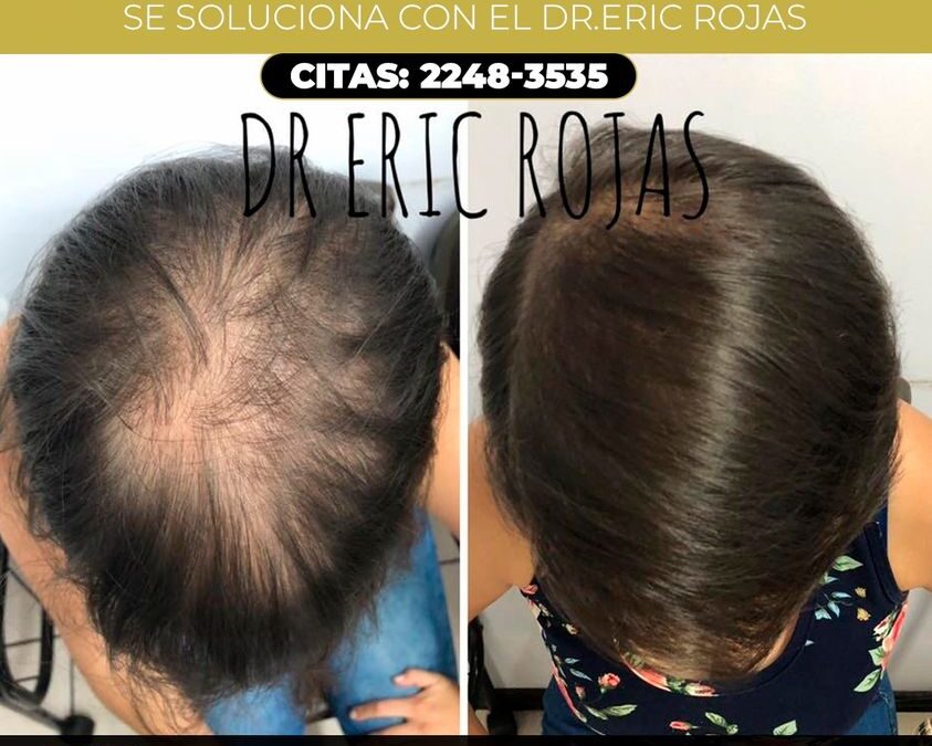 Control caida de cabello con el Dr. Eric Rojas Blanco.
