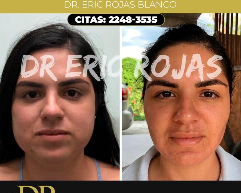 Bichectomía, Dr. Eric Rojas Blanco.