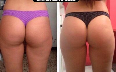 Realizamos tratamientos para la celulitis.