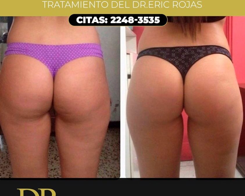 Realizamos tratamientos para la celulitis.