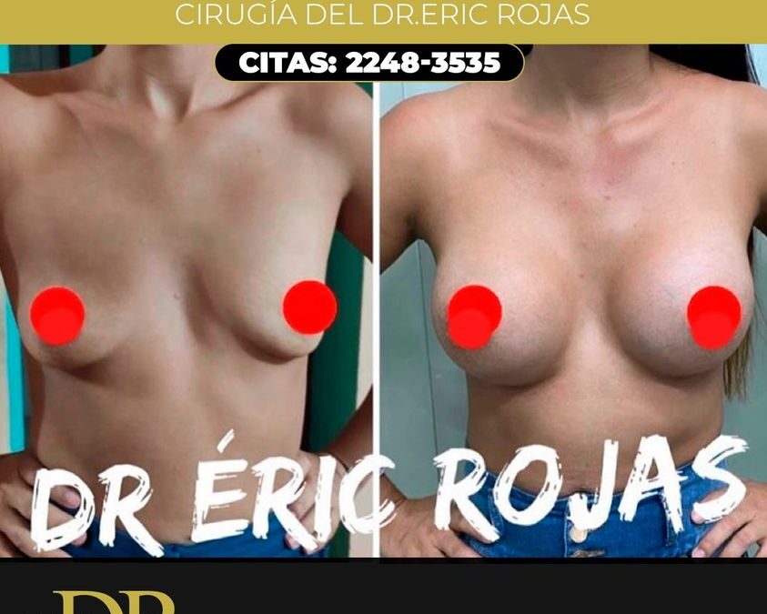 Aumento de mamas.