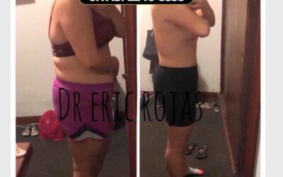 Antes y después de nuestro tratamiento de mesoterapia.