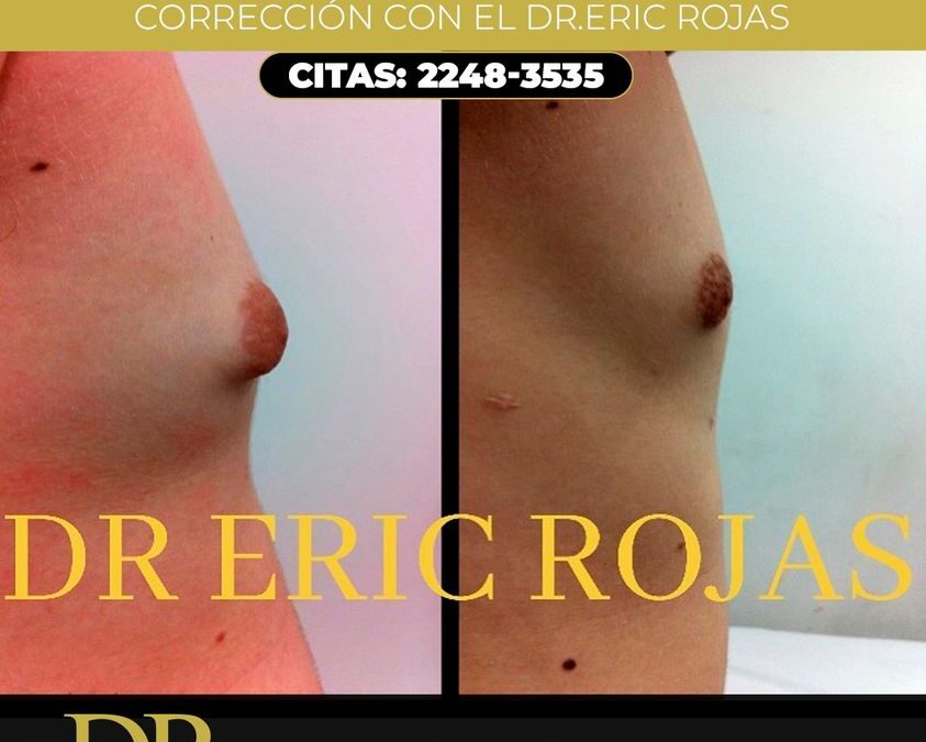 Corrección de ginecomastia.
