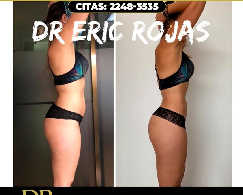 Procedimiento Slim Láser con el Dr.Eric Rojas.