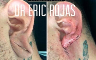 Si existe solución, reconstrucción de oreja.
