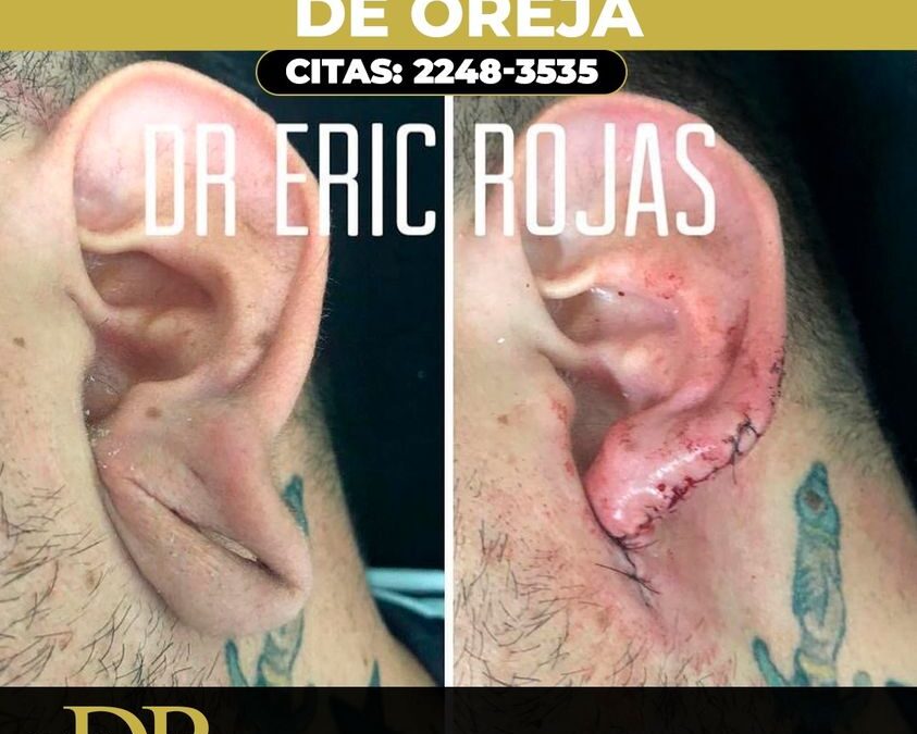 Si existe solución, reconstrucción de oreja.