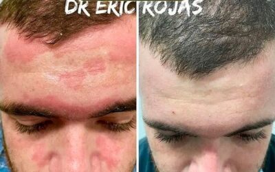 Nuestro tratamiento para la dermatitis seborreica, Dr. Eric Rojas.
