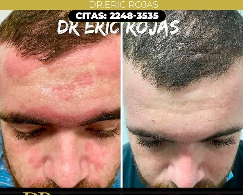 Nuestro tratamiento para la dermatitis seborreica, Dr. Eric Rojas.