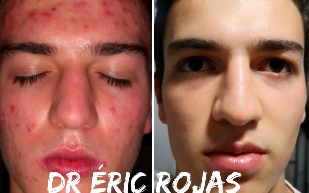 Obtén tu rostro perfecto con nuestro tratamiento para el acné.