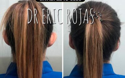 Corrección de Orejas.