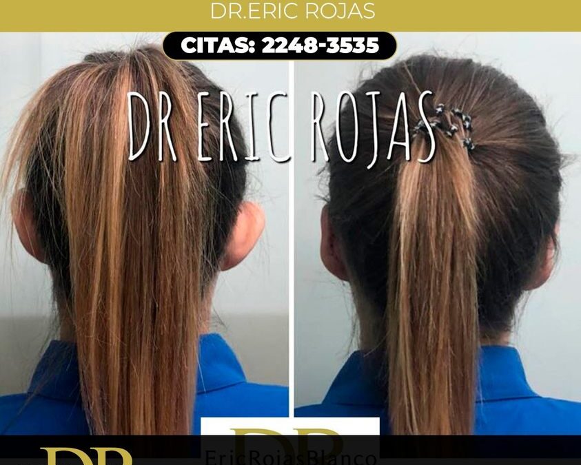 Corrección de Orejas.