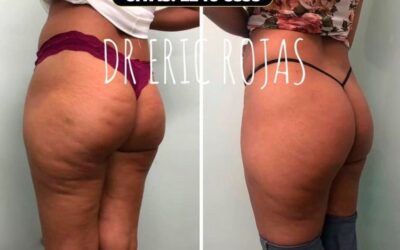 Dile adiós a la celulitis.