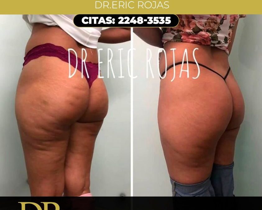 Dile adiós a la celulitis.