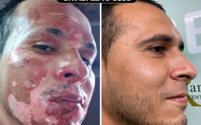Paciente con quemaduras, acá su recuperación con nuestro tratamiento, Dr. Eric Rojas.