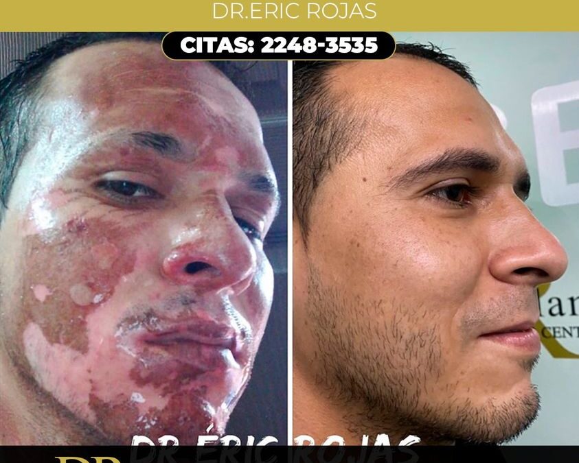 Paciente con quemaduras, acá su recuperación con nuestro tratamiento, Dr. Eric Rojas.