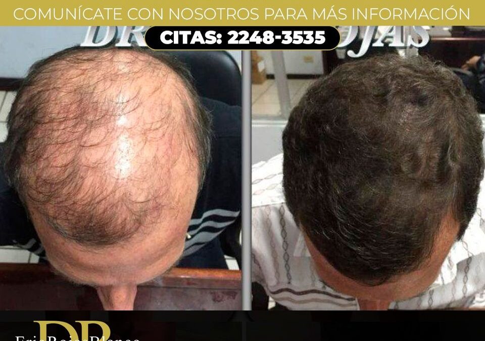 No te quedes sin pelo.