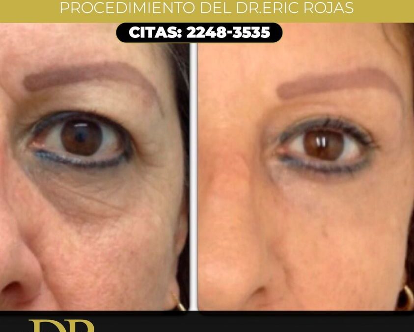 Procedimiento de párpados sin cirugía, del Dr. Eric Rojas Blanco.