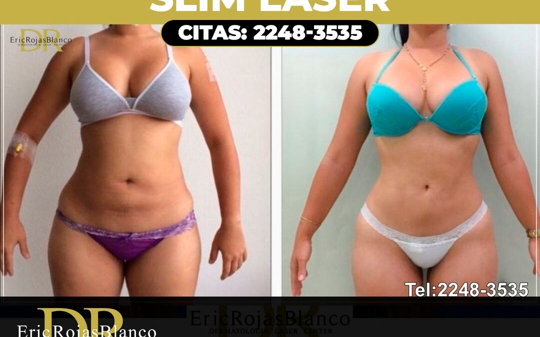 SLIM LÁSER, antes y después con el Dr. Eric Rojas.