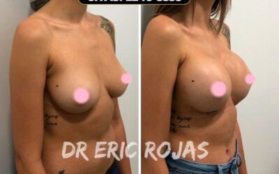 Aumento de mamas Dr. Eric Rojas.