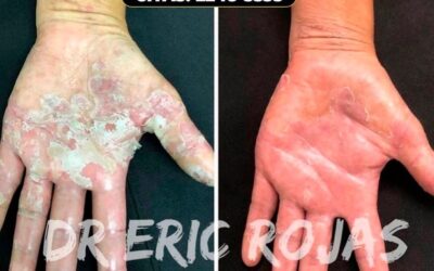Tratamiento para dermatitis por contacto.
