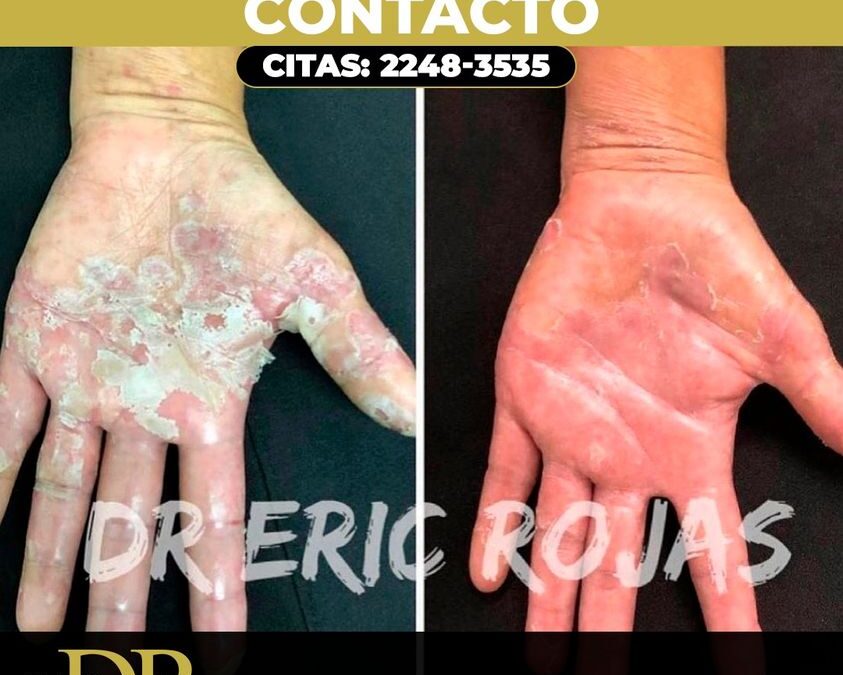 Tratamiento para dermatitis por contacto.