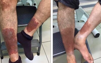 La Psoriasis es una enfermedad de la piel que causa manchas rojas y escamosas que pican.