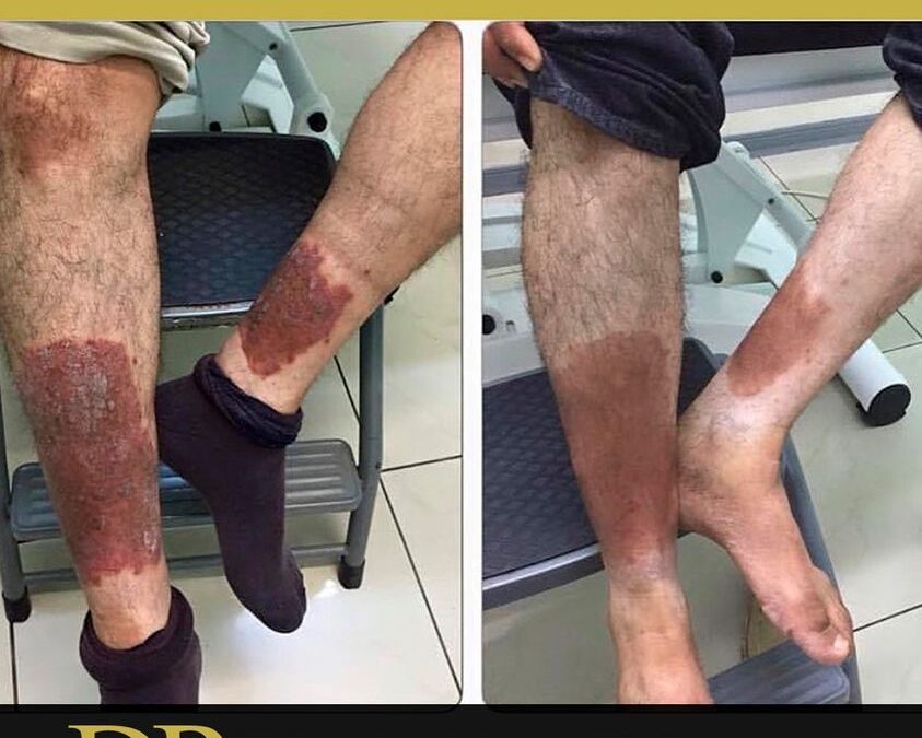 La Psoriasis es una enfermedad de la piel que causa manchas rojas y escamosas que pican.
