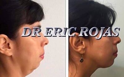 Corrección de papada, Dr. Eric Rojas Blanco.