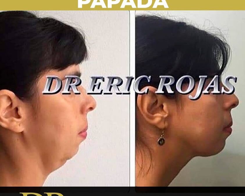Corrección de papada, Dr. Eric Rojas Blanco.