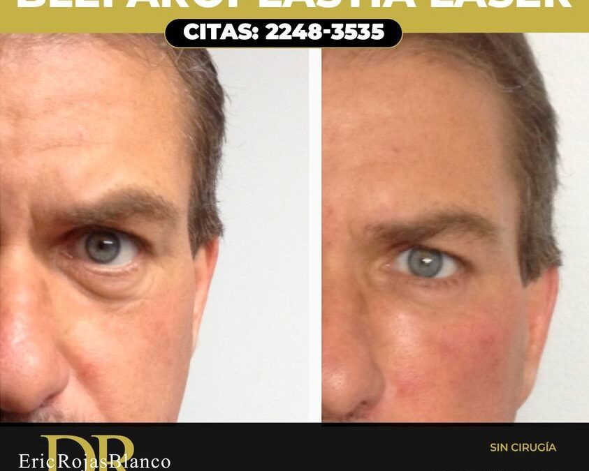 Blefaroplastía sin cirugía.