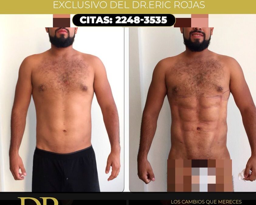 SLIM LÁSER, Dr. Eric Rojas Blanco.