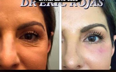 Rejuvenecimiento facial.