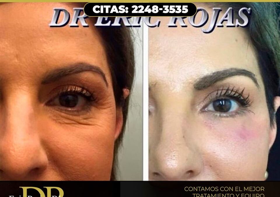 Rejuvenecimiento facial.