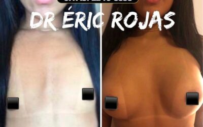 AUMENTO DE MAMAS, Dr.Eric Rojas Blanco.