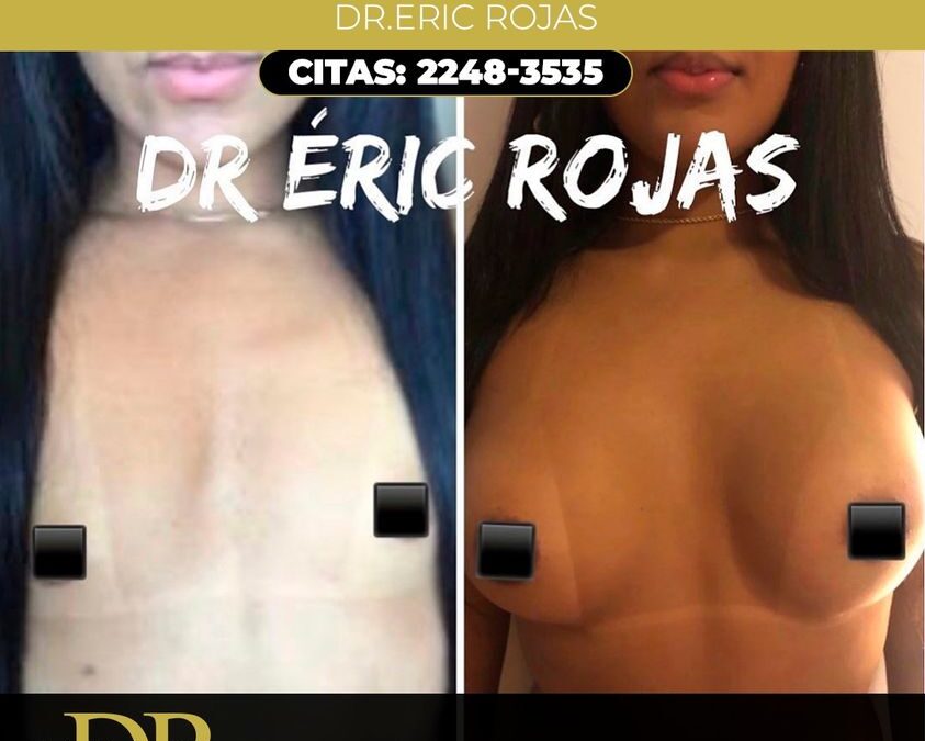 AUMENTO DE MAMAS, Dr.Eric Rojas Blanco.