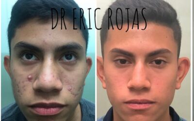 Tratamiento para el acné.